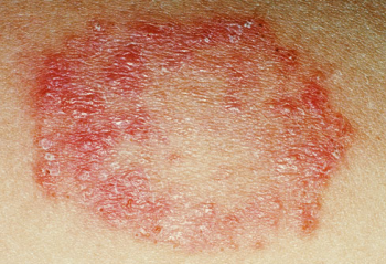Ringworm treatment dry skin