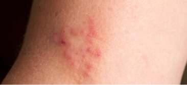 About ringworm treatment